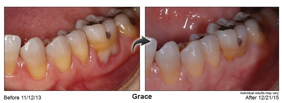 fix gum recession Coral Gables Florida