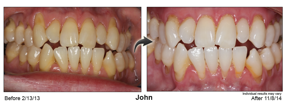 Coral Gables Florida gum recession