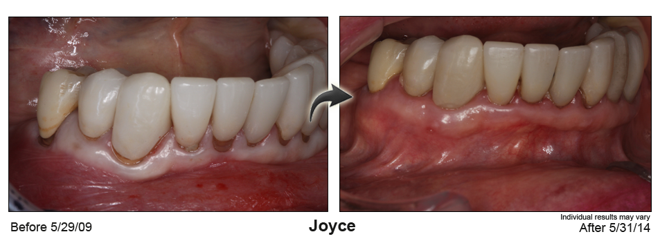 pinhole gum rejuvenation Coral Gables Florida