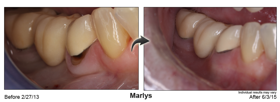 fix receding gums Coral Gables Florida