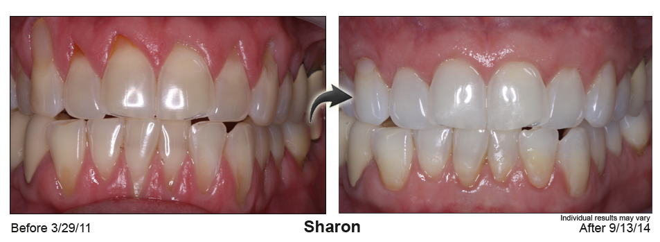 gum recession treatment Coral Gables Florida